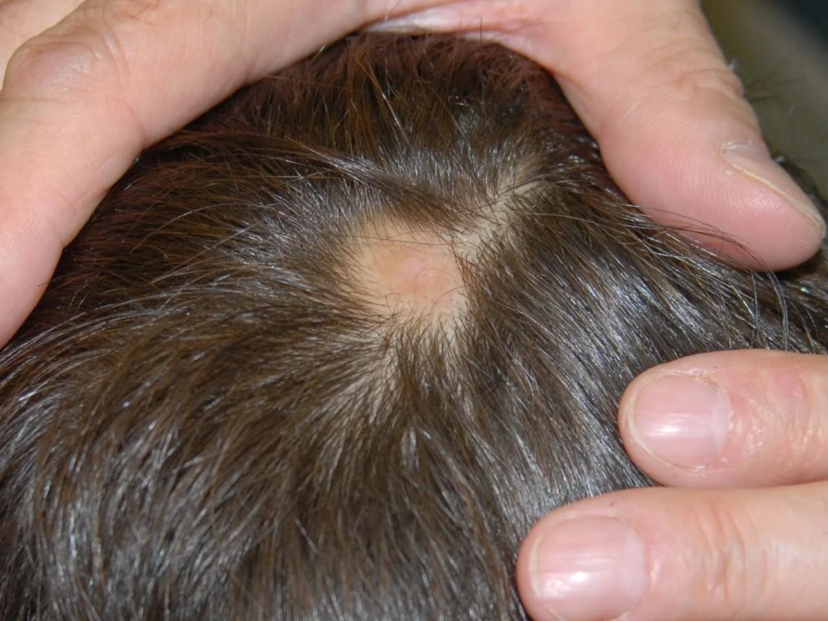 Come prevenire la caduta dei capelli 7 consigli utili